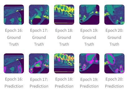 Spleen Segmentations Predictions vs Ground Truth